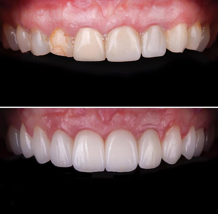 faccette dentali: prima e dopo 